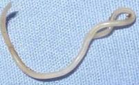 20-cm-length-worm-taken-by-surgery-from-the-face-of-a-lady