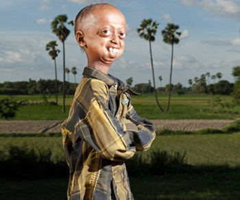 progeria-the-rare-disorder-that-makes-teenager-boy-look-110-year-old