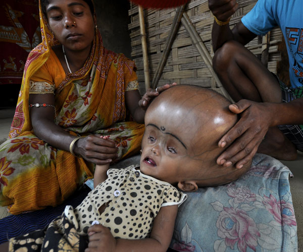 runa-begum-girl-in-india-with-swollen-head-offered-help-by-fortis-hospital-to-treat-hydrocephalus