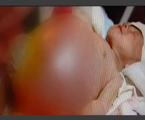 2-year-old-child-delivered-a-baby