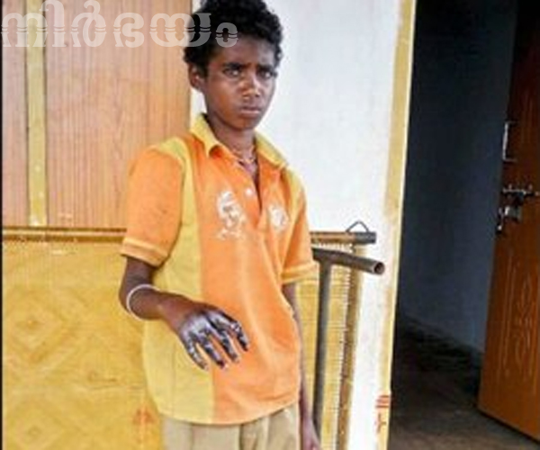 brutally-burned-hands-of-11-year-old-boy