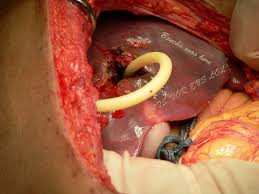 surgeon-allegedly-branded-his-initials-on-patients-liver
