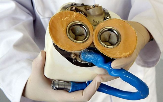 first-human-artificial-heart-transplant-performed-in-france