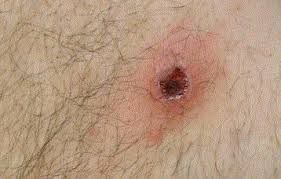 scrub-typhus-in-kerala