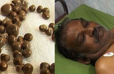 kidney-stone-removed-from-a-patient