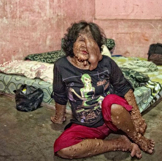 woman-with-neurofibromatosis-covered-in-tumours-she-cannot-afford-to-treat