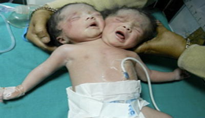 the-baby-with-two-heads