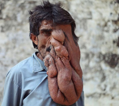 indias-elephant-man-who-struggles-with-huge-facial-tumour