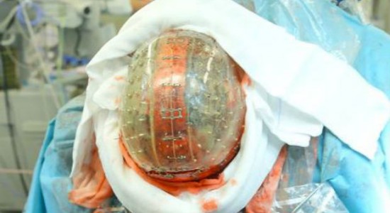 volledige-kunststof-3d-geprinte-schedel-geimplanteerd