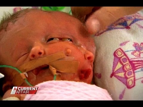 conjoined-twins-faith-and-hope-pass-away