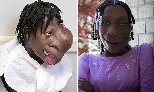 four-pound-tumor-removed-from-15-years-old-girl-face