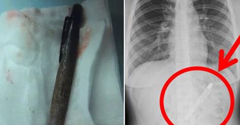 womans-stomach-aches-were-caused-by-four-inch-fountain-pen-that-she-swallowed-six-months-previously