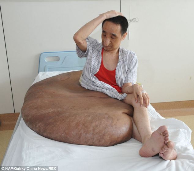 worlds-largest-tumour-weighs-110kg-removed-from-mans-leg