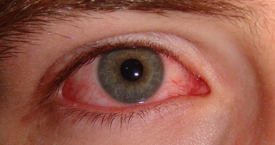 conjunctivitis-facts