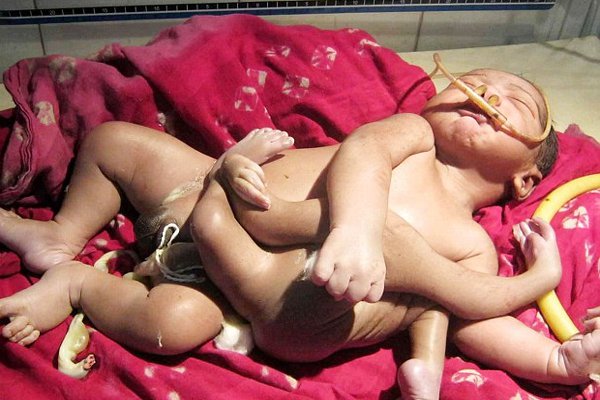baby-born-with-four-arms-and-four-legs