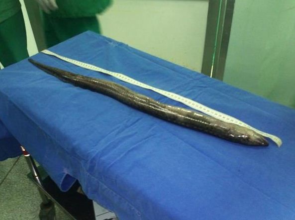 doctors-in-brazil-removed-a-south-american-lungfish-from-a-mans-bowel
