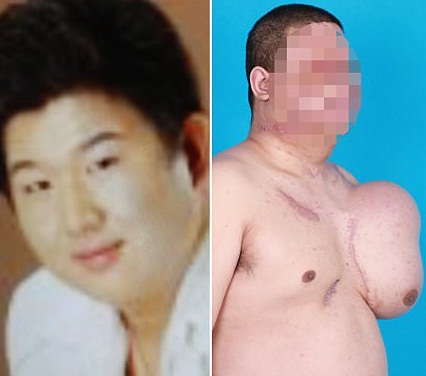 the-man-with-a-new-face-growing-on-his-chest