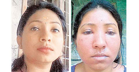 woman-face-gets-burned-after-getting-facial