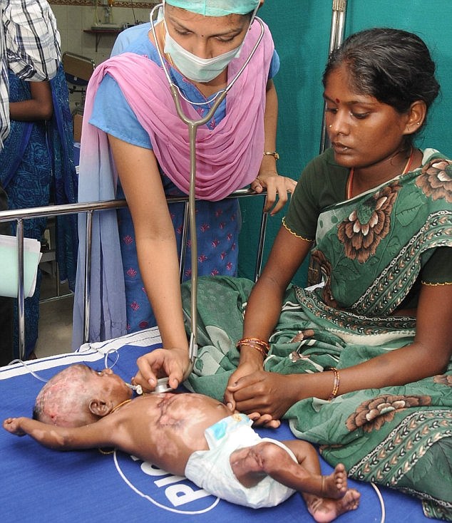 indian-parents-claim-their-six-day-old-spontaneously-combusted