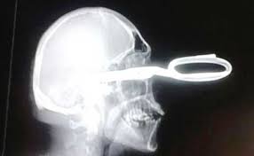 man-with-scissors-lodged-in-head-politely-asks-for-help
