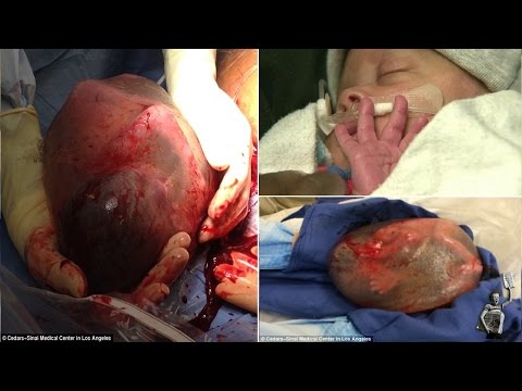 premature-baby-born-inside-amniotic-sac