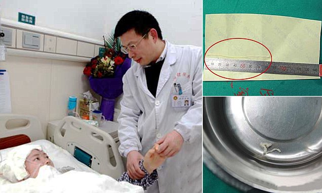 chinese-woman-has-8cm-parasite-removed-from-her-brain