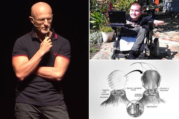 first-human-head-transplant-could-happen-in-two-years