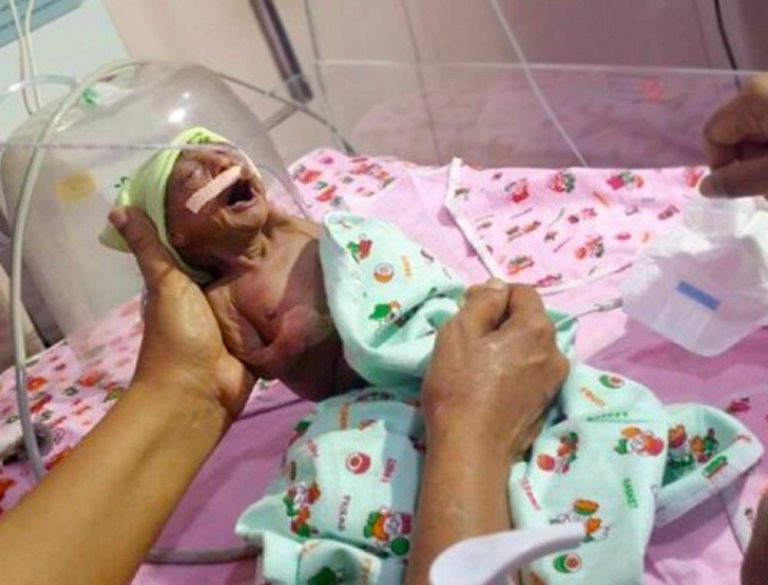 newborn-baby-girl-abandoned-by-parents-because-rare-condition-has-left-her-skin-wrinkly