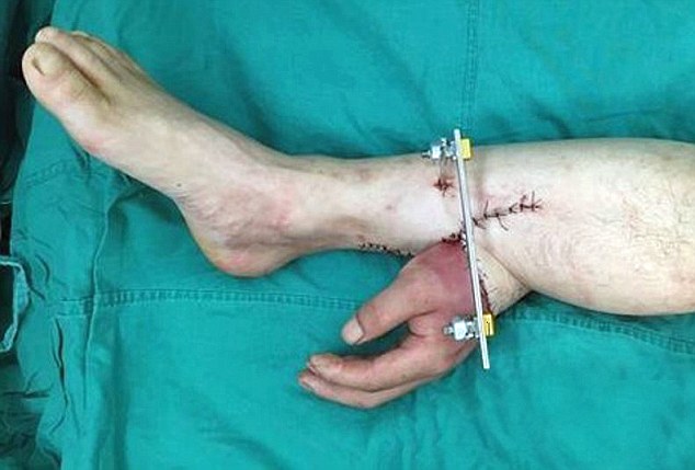 chinese-mans-severed-hand-reattached-after-it-was-grafted-to-his-leg