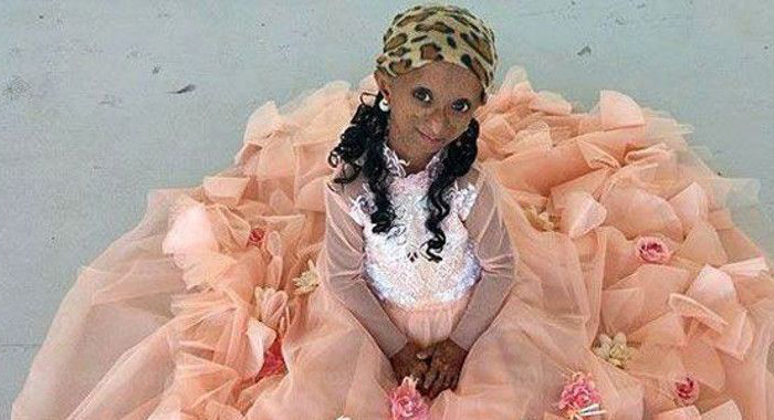 progeria-sufferer-rochelle-pondare