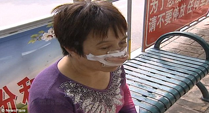 chinese-woman-says-her-husband-bit-off-her-nose-and-ate-it