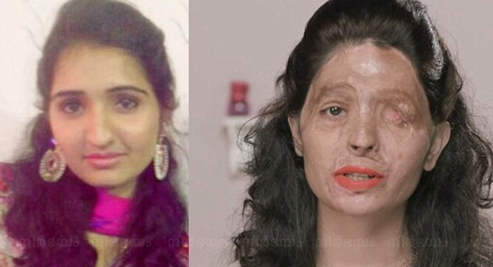 acid-attack-victim-reshma