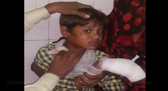 5-year-old-mp-boy-loses-5-fingers-in-mobile-blast
