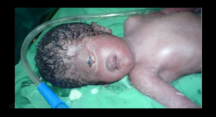 baby-in-egypt-born-with-only-one-eye-and-no-nose-after-being-exposed-to-radiation
