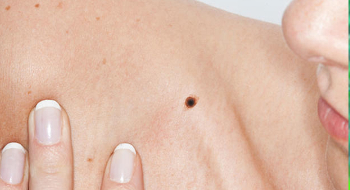 arm-mole-count-shows-skin-cancer