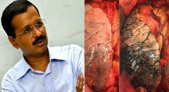 arvind-kejriwal-shares-pictures-of-lungs-on-twitter-post-goes-viral