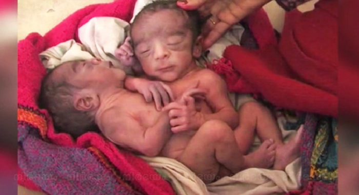 conjoined-twins-born-in-india-after-smooth-pregnancy-without-ultrasound