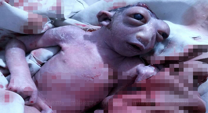 miracle-baby-born-without-a-head-survived-for-48-hours