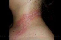 13-year-old-girl-suffers-second-degree-burns-after-mobile-phone-malfunctions