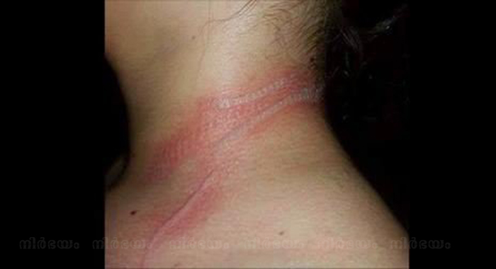 13-year-old-girl-suffers-second-degree-burns-after-mobile-phone-malfunctions