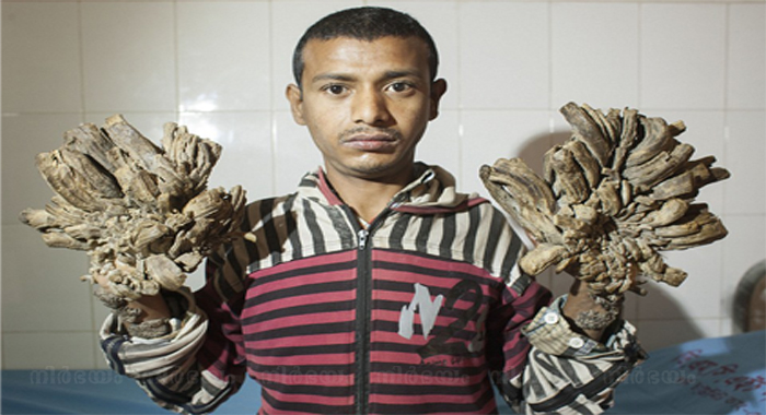 bangladeshi-man-suffers-rare-condition-that-causes-tree-like-roots