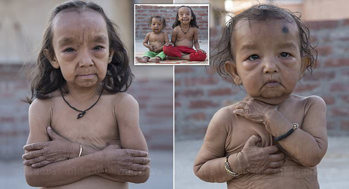 keshav-kumar-and-anjali-kumari-benjamin-button-children-look-like-pensioners