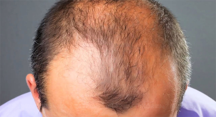 home-remedies-for-baldness