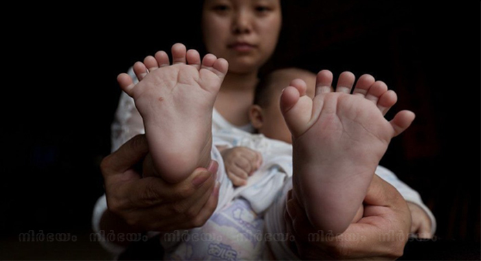chinese-baby-born-with-31-fingers-toes