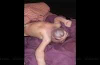baby-girl-born-without-skull-dies-in-jharkhand