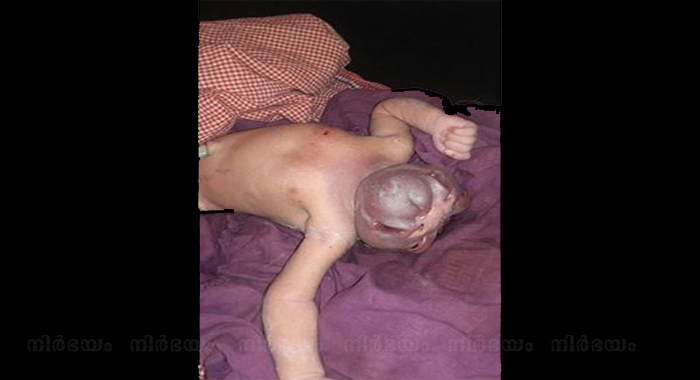 baby-girl-born-without-skull-dies-in-jharkhand