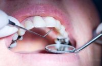 bad-teeth-good-gums-linked-to-lower-headneck-cancer-risk