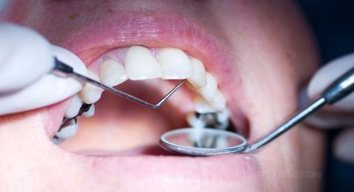 bad-teeth-good-gums-linked-to-lower-headneck-cancer-risk