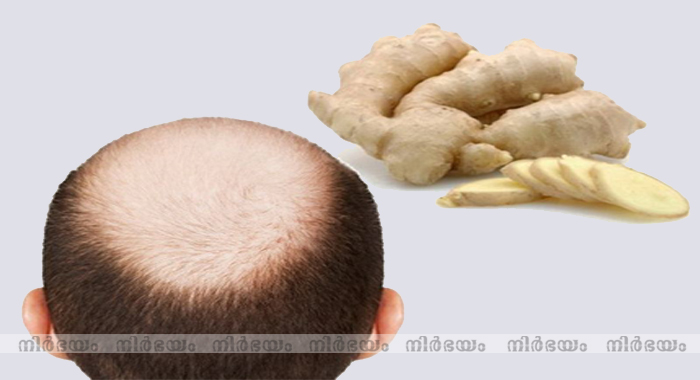 ginger-for-baldness