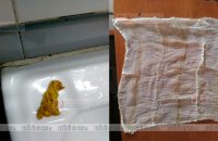 cloth-found-in-stomach-after-surgery